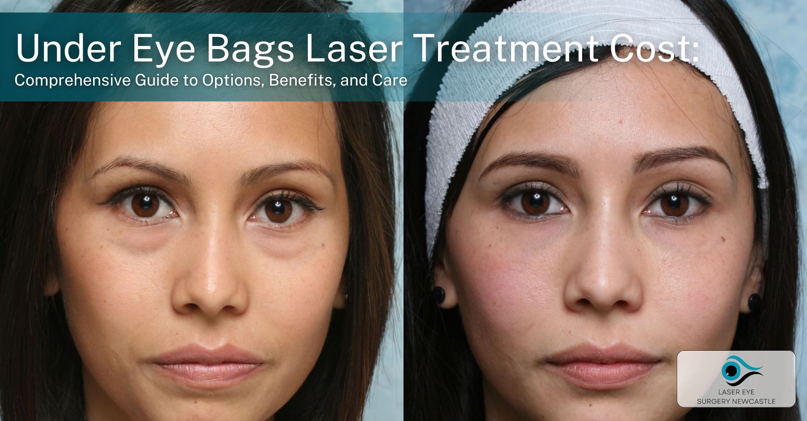 under eye bags laser treatment cost